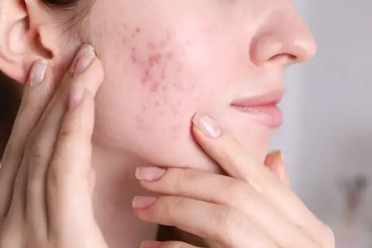 Bien-être et SOPK skincare sport